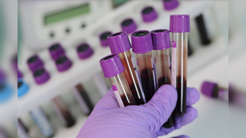 Estudo aponta biomarcadores que poderão indicar progressão da Covid19